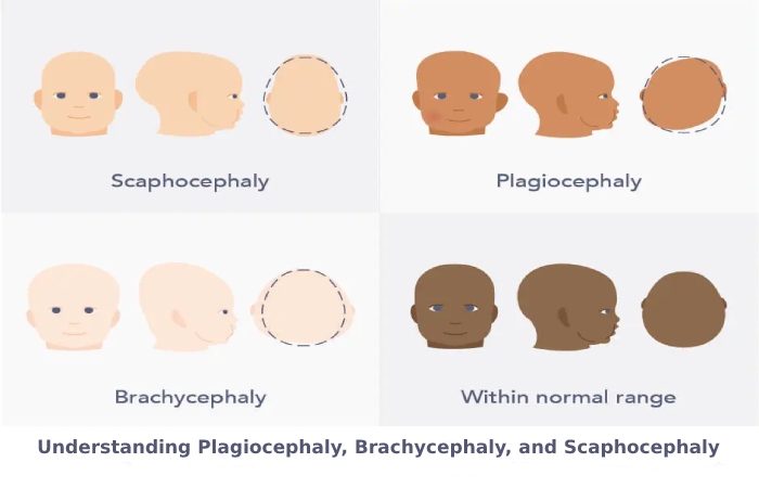 Understanding Plagiocephaly, Brachycephaly, and Scaphocephaly